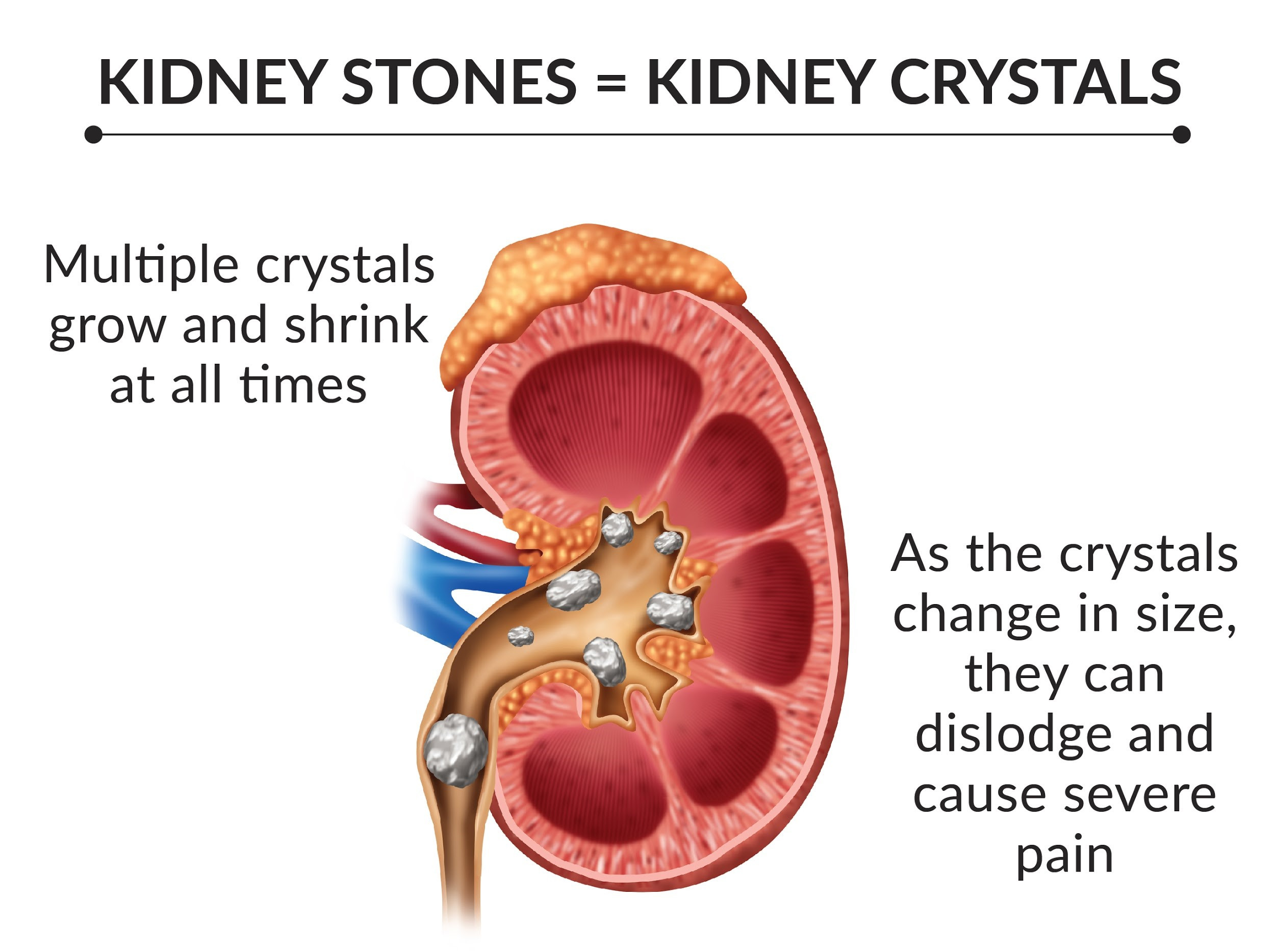 Keto Diet And Kidney Stones
 Keto Diet and Kidney Stones Ketogenic Diet 101