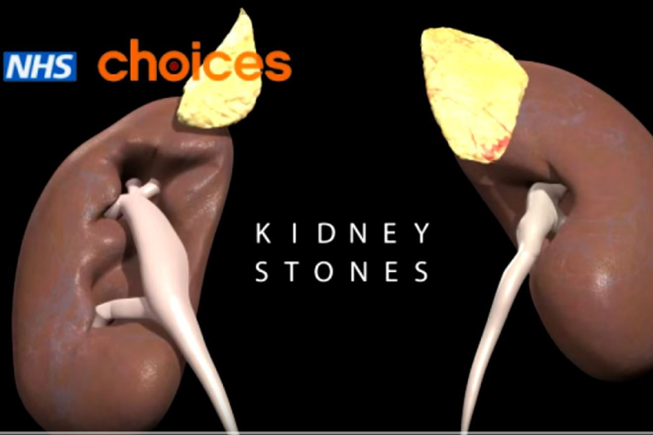 Keto Diet Kidney Pain
 Kidney Stones Symptoms Nhs